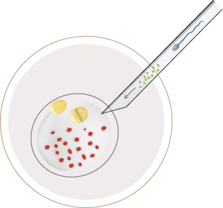 in vitro fertilization